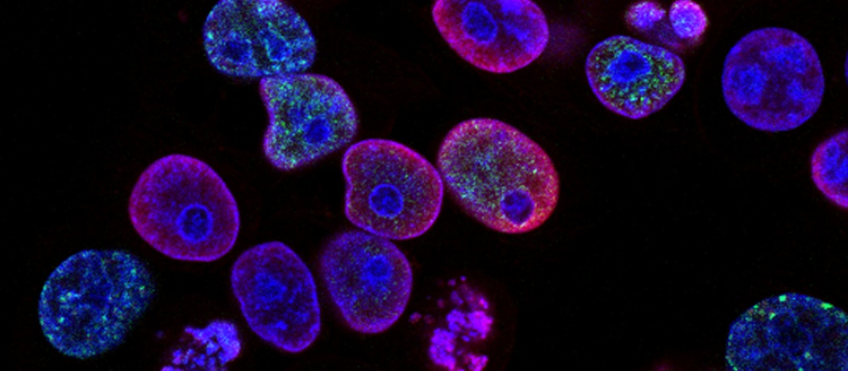 Cellulitis bacterial skin infection treatment