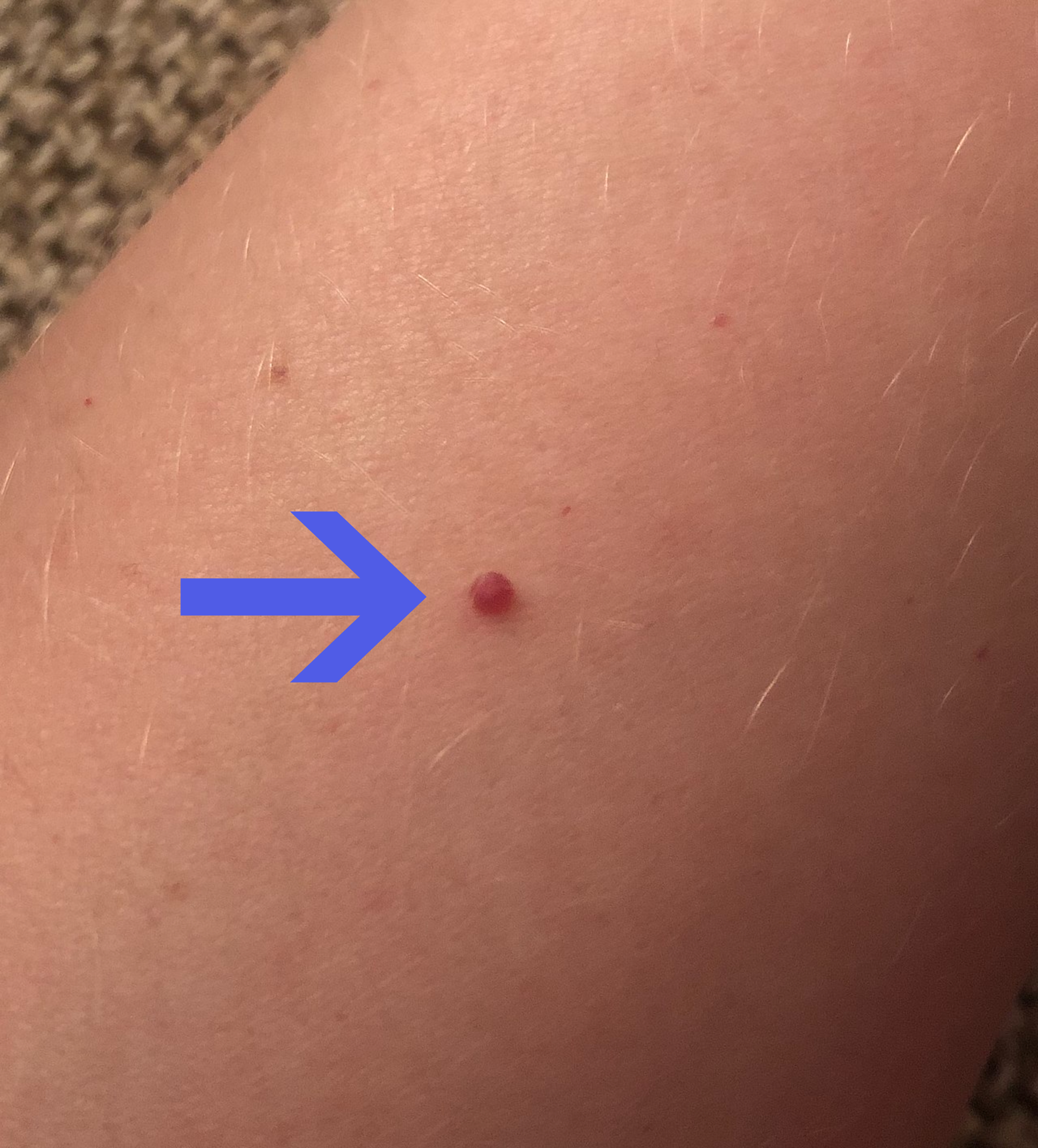 Cherry hemangioma on skin