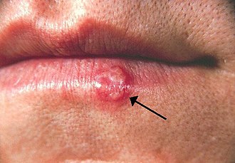 Herpes simplex virus – hudlidelse behandling