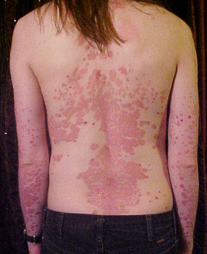 Psoriasis – chronic autoimmune skin disease