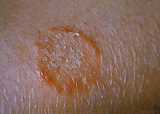Ringworm tinea fungal skin infection